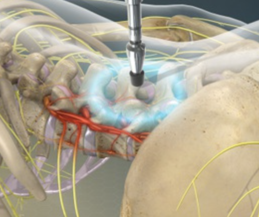 Activator adjusting tool delivering a precise low-force spinal adjustment