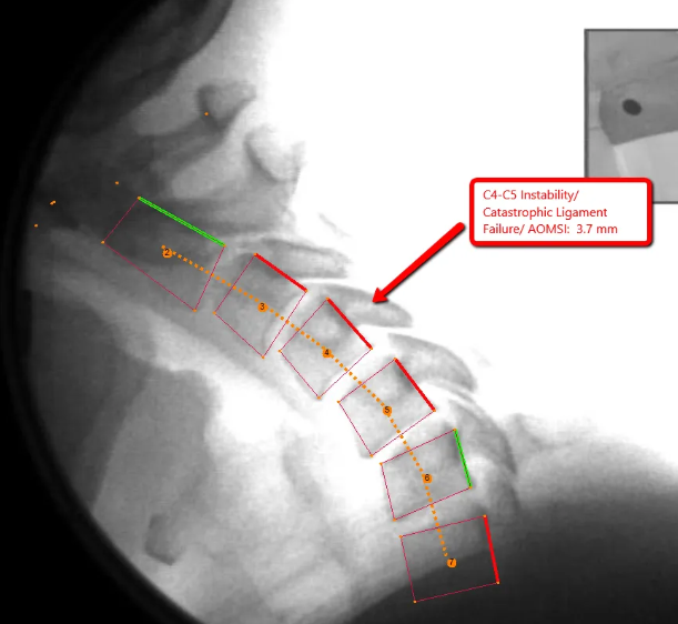 Digital Motion X-Ray fluoroscopic image showing C4-C5 spinal instability — Optimum Chiropractic Care Mobile AL