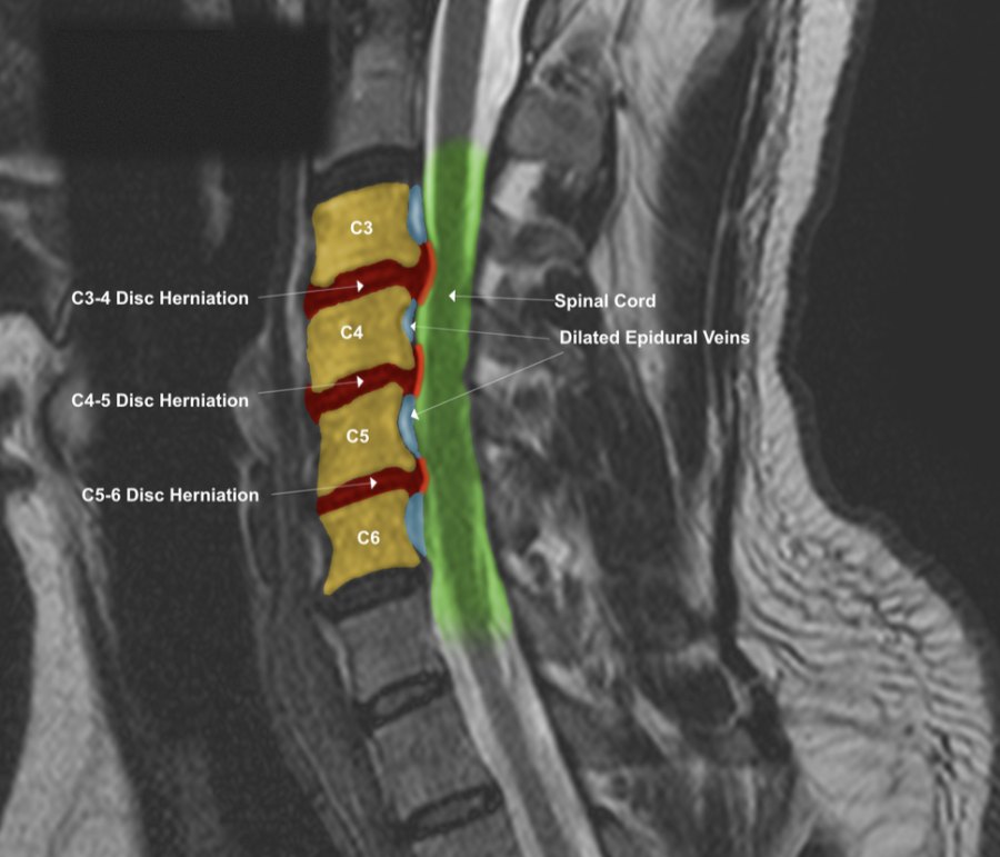 How MRI Colorization Makes Spinal Findings Easier to See