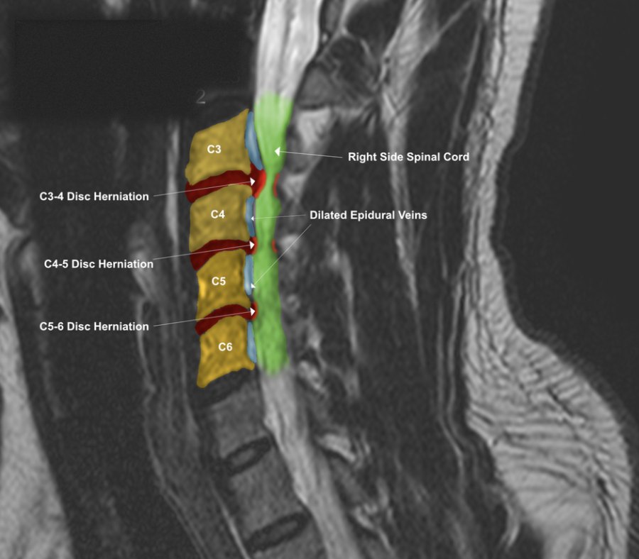 Right parasagittal T2 MRI with labeled color overlays showing disc herniations, the spinal cord, and dilated epidural veins