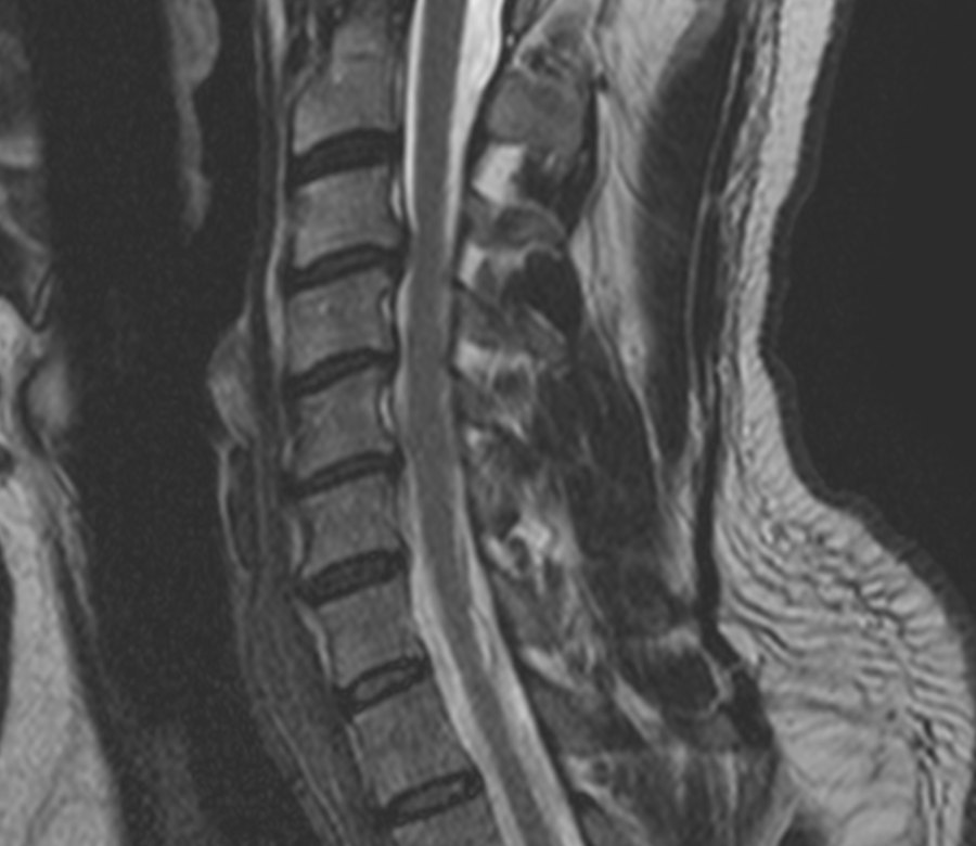 Original sagittal T2 MRI of the cervical spine in grayscale