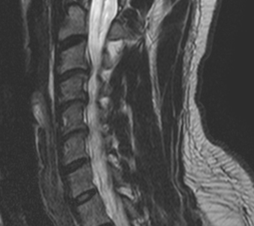 Original right parasagittal T2 MRI of the cervical spine in grayscale