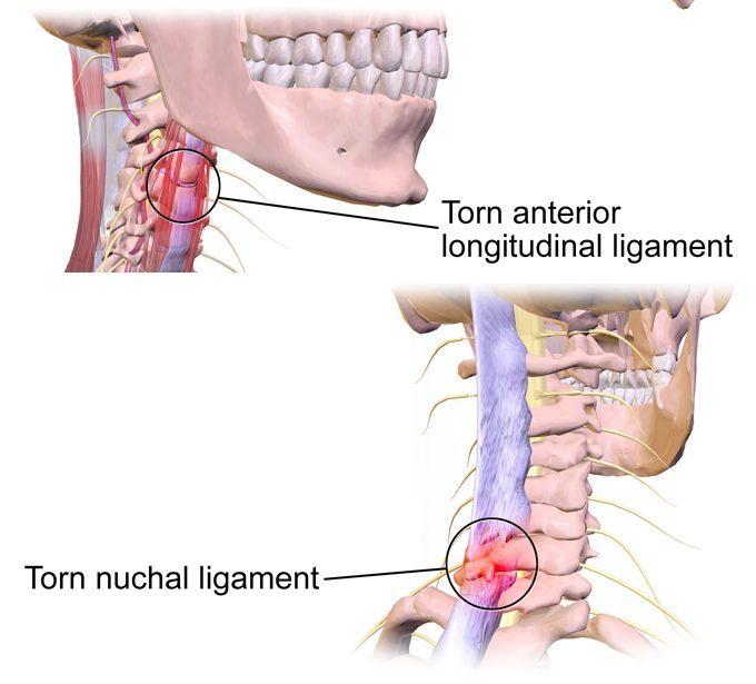 Illustration of a torn anterior longitudinal ligament and torn nuchal ligament in whiplash