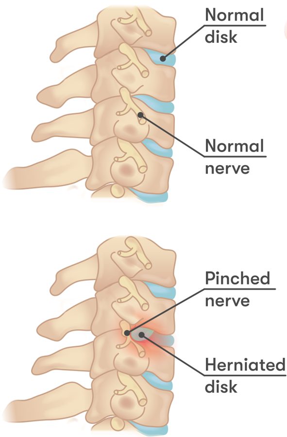 Comparison of a normal cervical disc and a herniated disc pinching a nerve