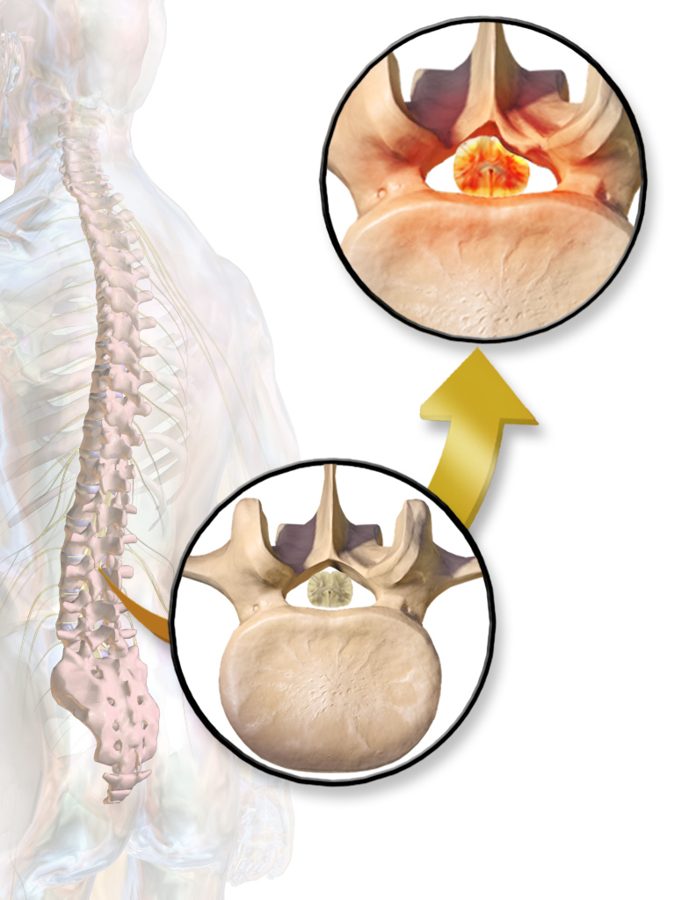 Illustration of spinal canal narrowing in spinal stenosis